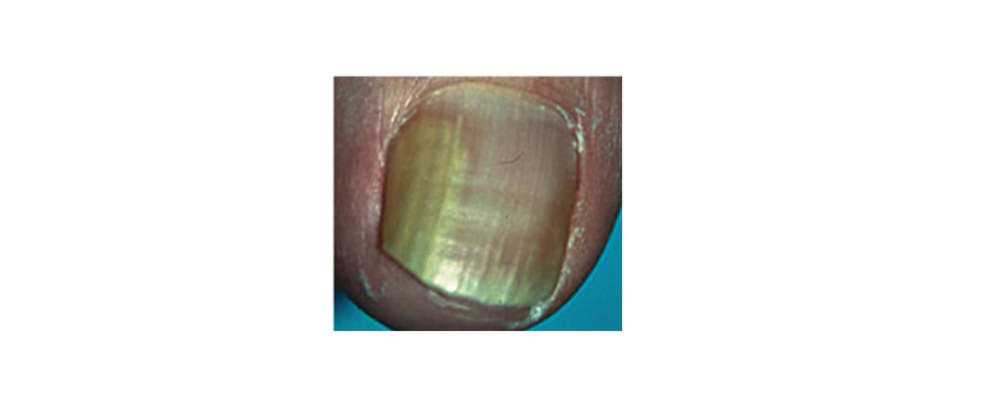 Онихолизис