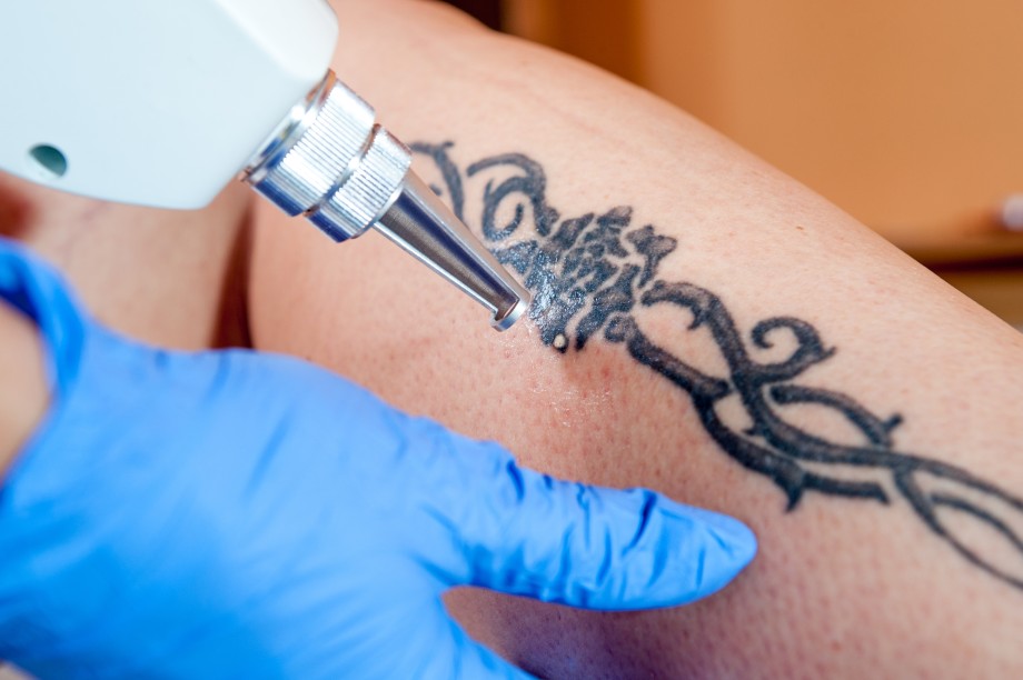 лазер для удаления татуировок