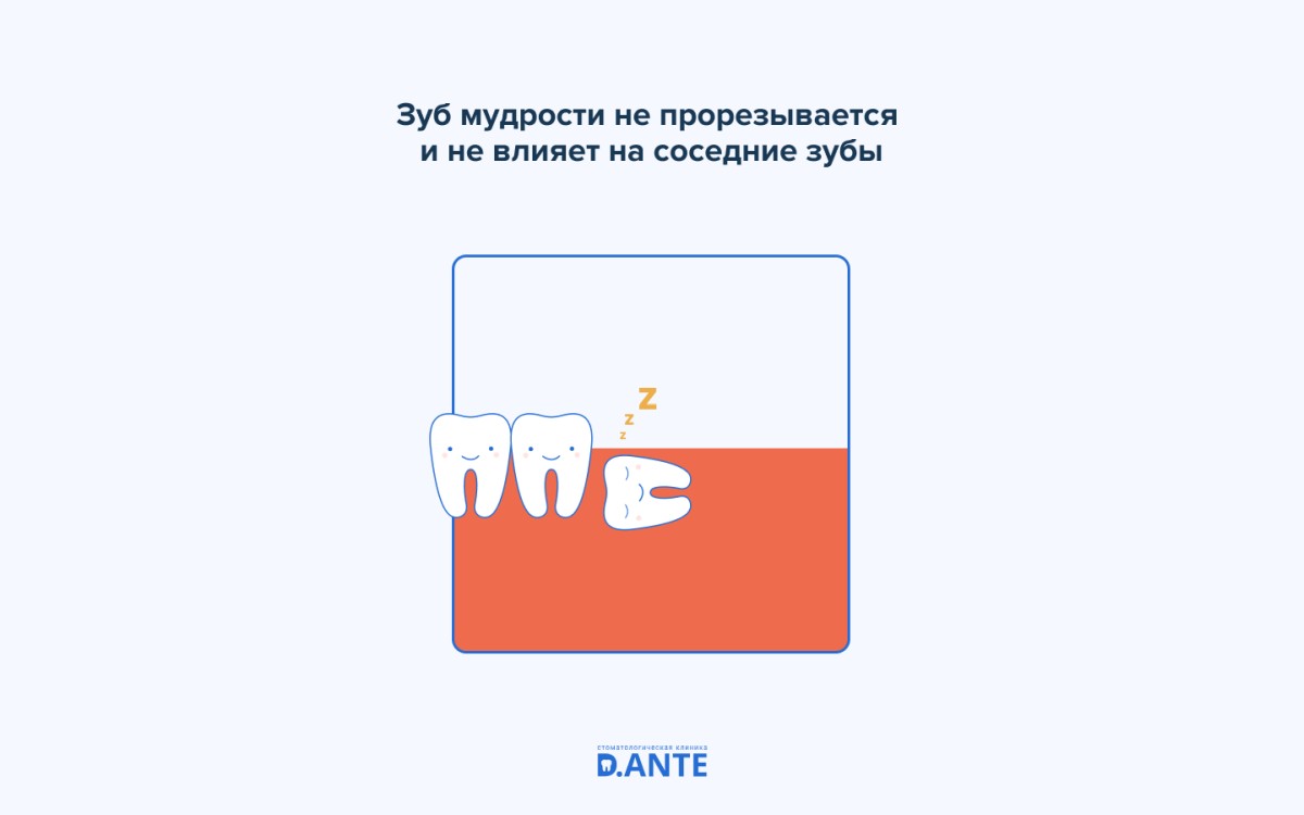 Самые непредсказуемые зубы — зубы мудрости