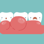 Киста зуба: от небольшого воспаления до перелома челюсти