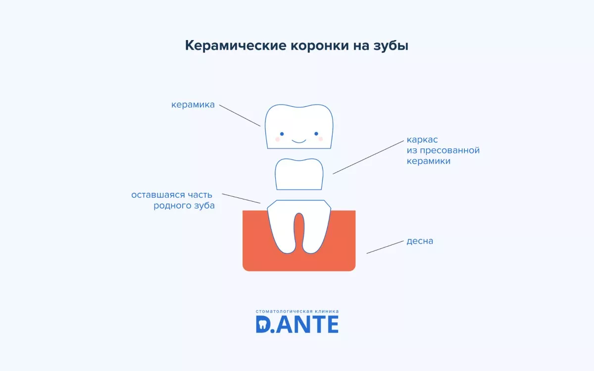 Коронки на зуби: показання, види, вартість 