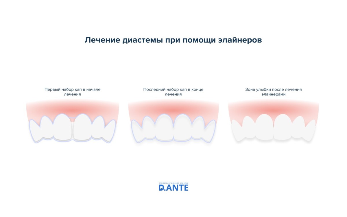 Лечение диастемы при помощи элайнеров