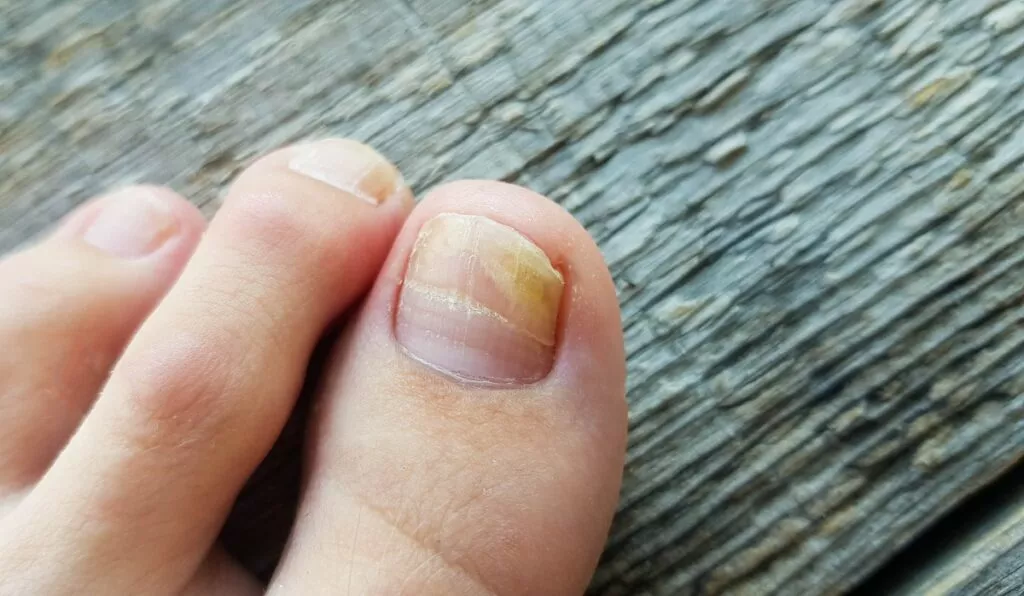 Что делать, если желтеют ногти на ногах