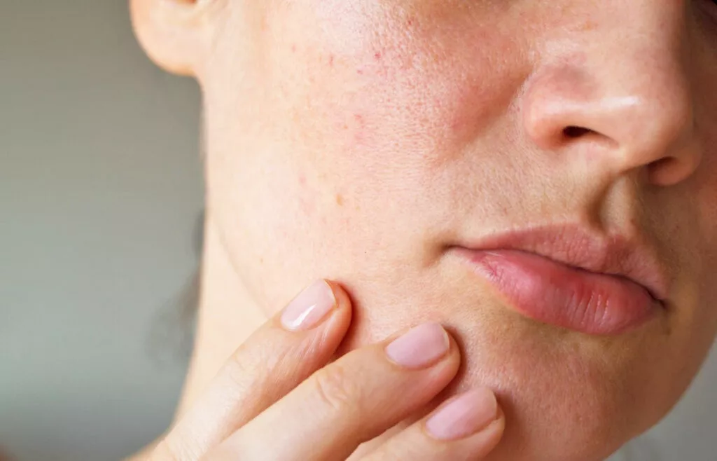 Обезвоженная кожа лица: как справиться с проблемой и не допускать ее впредь  - Beauty HUB