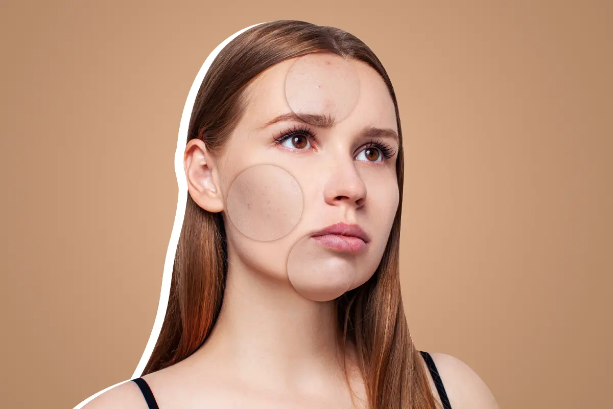 лечение постакне