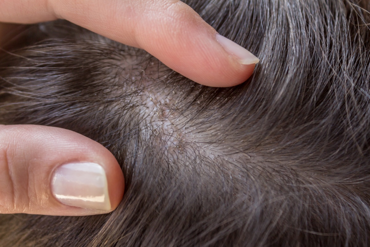Болезни кожи головы: причины, последствия и лечение