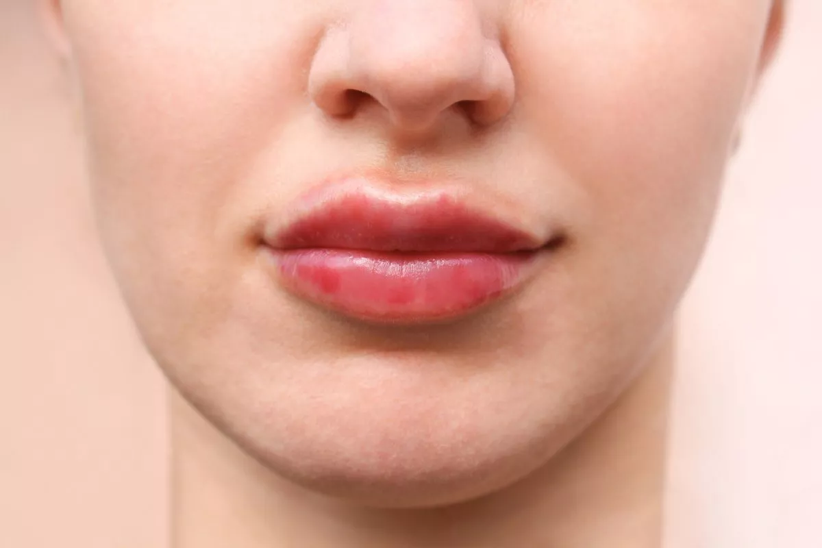 гиалуроновые усы