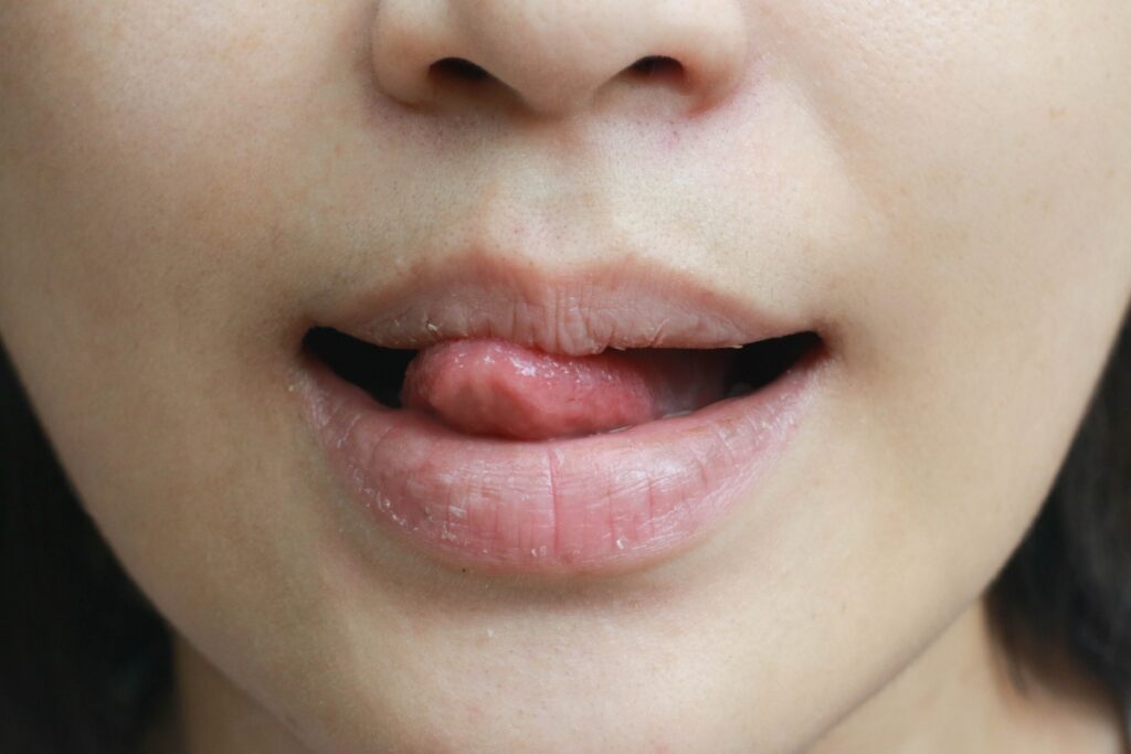 Заеды в уголках рта: почему появляются и как лечить