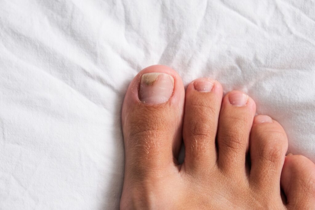 Відшарування нігтя: чому відбувається і як лікувати оніхолізис