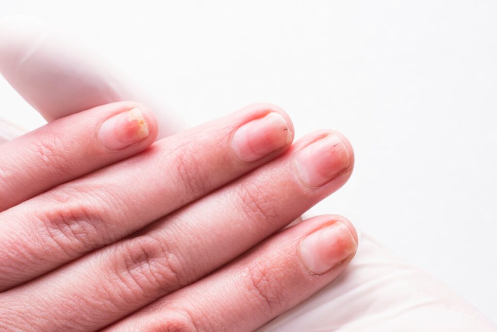 Відшарування нігтя: чому відбувається і як лікувати оніхолізис
