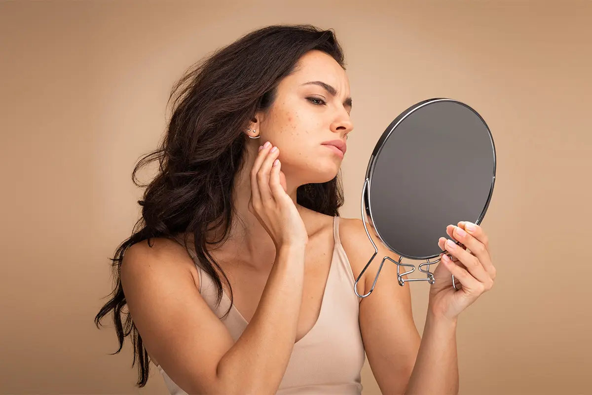 Акне і постакне